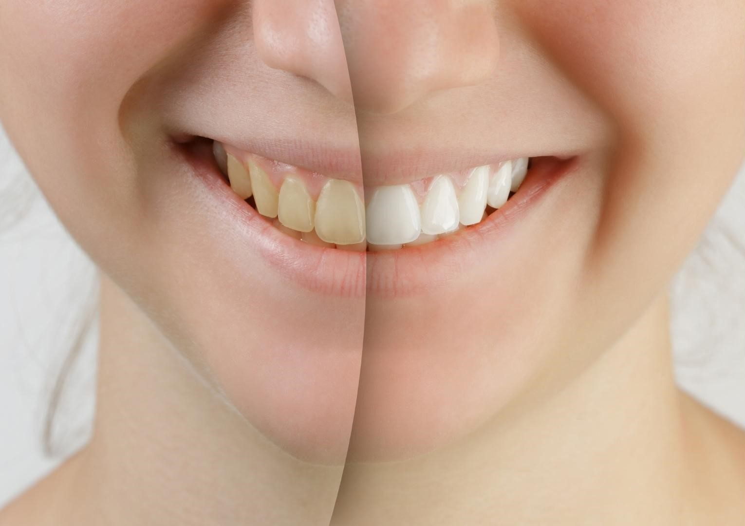 Teeth whitening difference